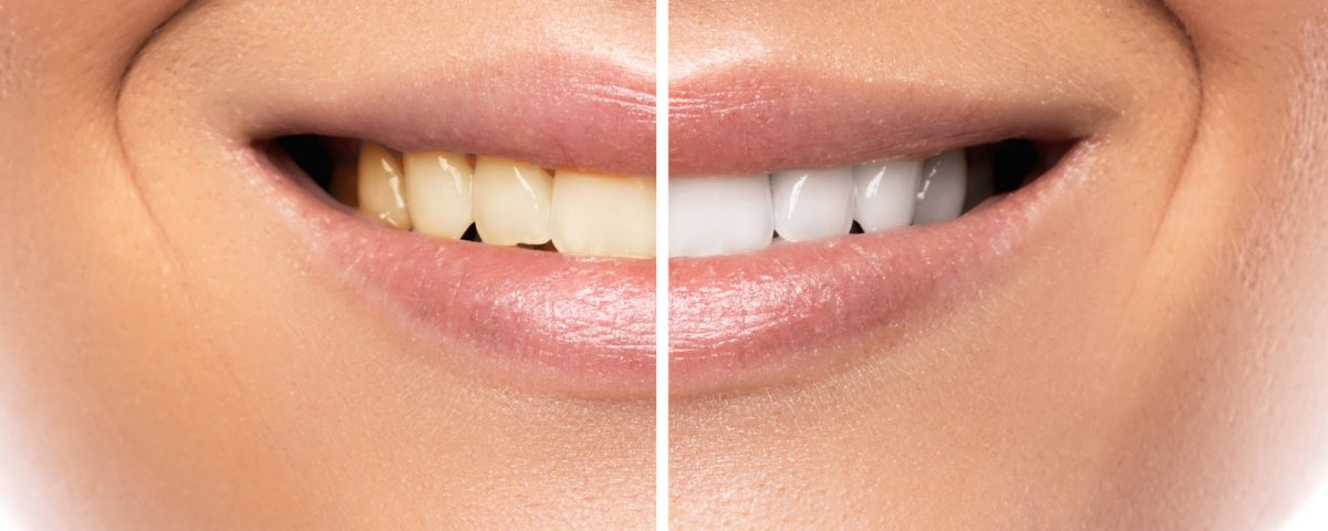 Skuteczne wybielanie zębów domowymi sposobaAmi albo lampą beyound