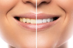 Skuteczne wybielanie zębów domowymi sposobaAmi albo lampą beyound